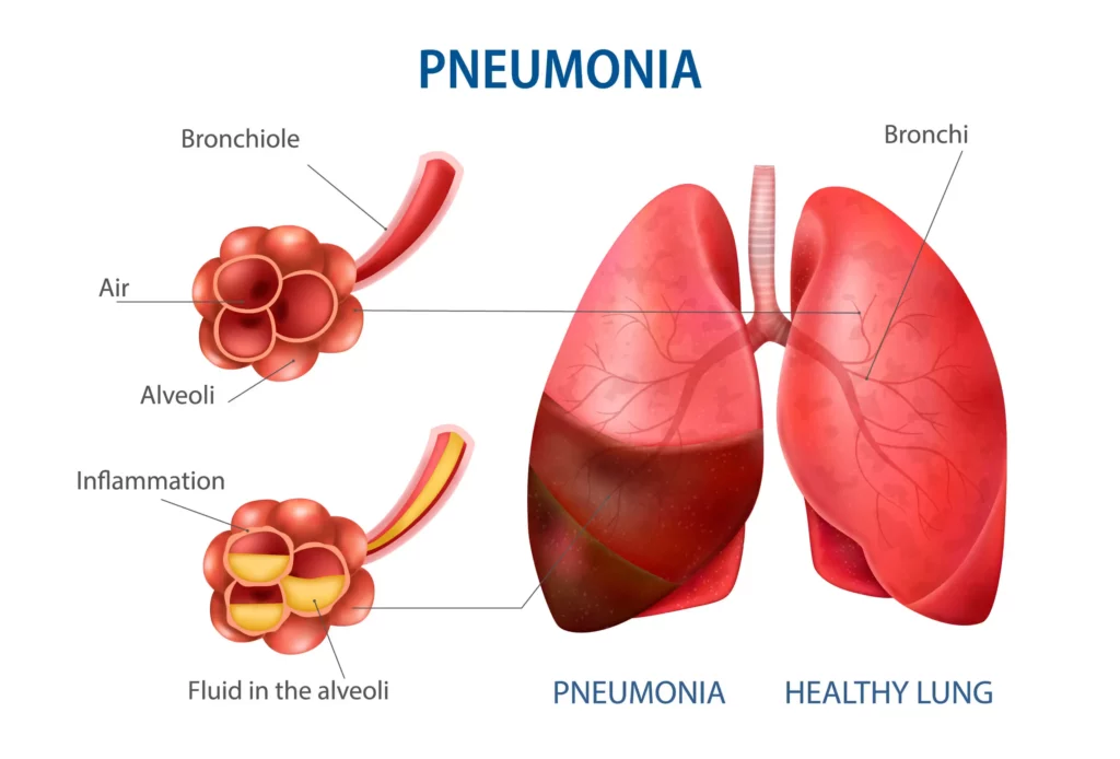 realistic pneumonia human set (1)