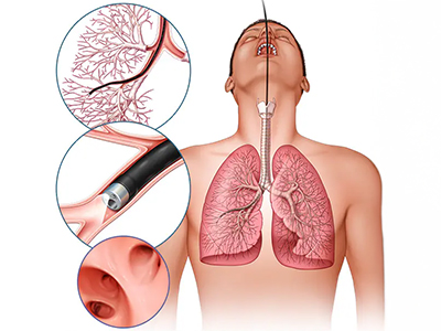 Bronchoscopy Services in Jaipur