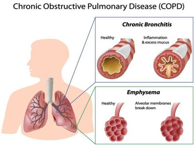 COPD Treatment in Jaipur