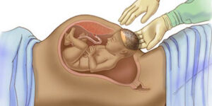 Cesarean Delivery in Jaipur