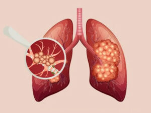 Interstitial Lung Disease (ILD) Care at Dr. Narang’s Hospital, Jaipur