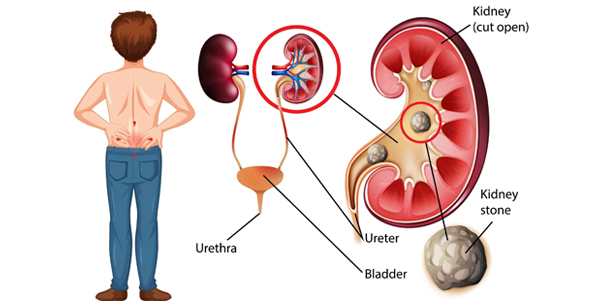 Kidney Stones – Diagnosis & Treatment in Jaipur