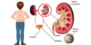 Kidney-Stones specialist in Jaipur