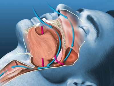 Obstructive Sleep Apnea (OSA) – Diagnosis and treatment in jaipur