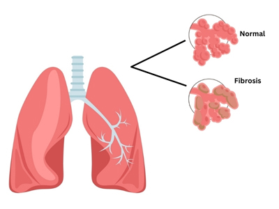 Pulmonary Fibrosis Treatment in Jaipur