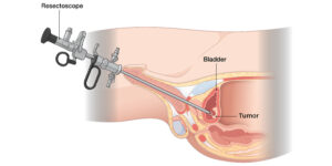 TURBT (Transurethral Resection of Bladder Tumor) in Jaipur