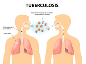 Tuberculosis (TB) treatment in Jaipur