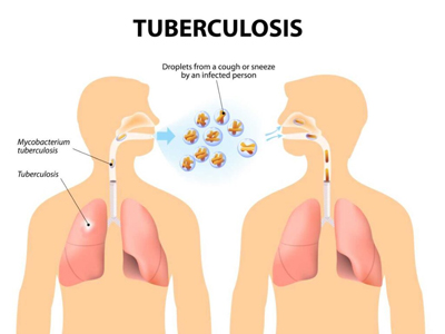 Tuberculosis (TB) treatment in Jaipur