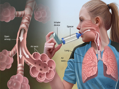 Asthma Specialist in Jaipur