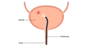 cystoscopy in Jaipur